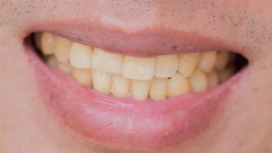 Reasons Your Teeth Are Turning Yellow These Days