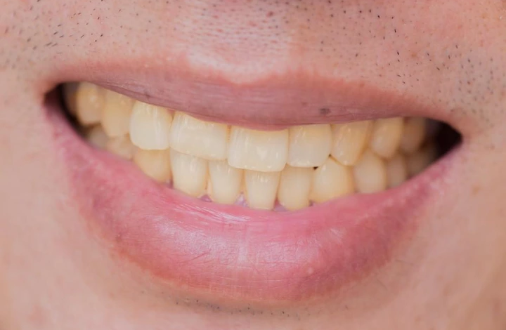 Reasons Your Teeth Are Turning Yellow These Days